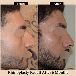 rhinoplasty-img12